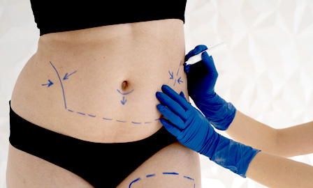 Procedimento Endolaser para tratamento de flacidez.