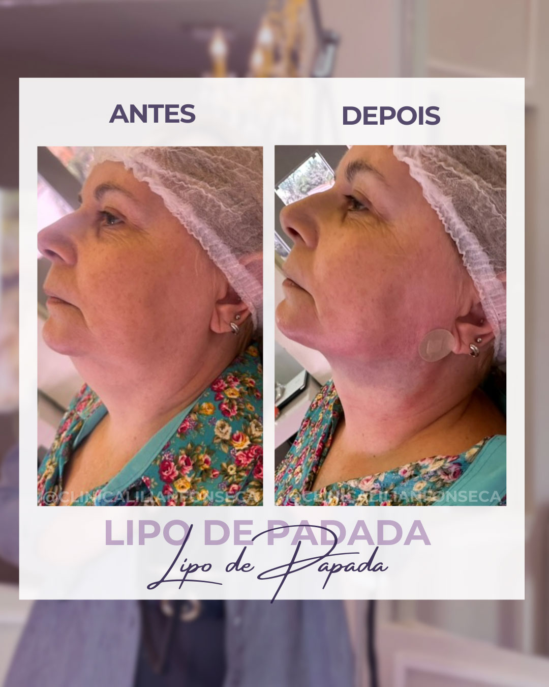 Resultado de Lipo de Papada 10