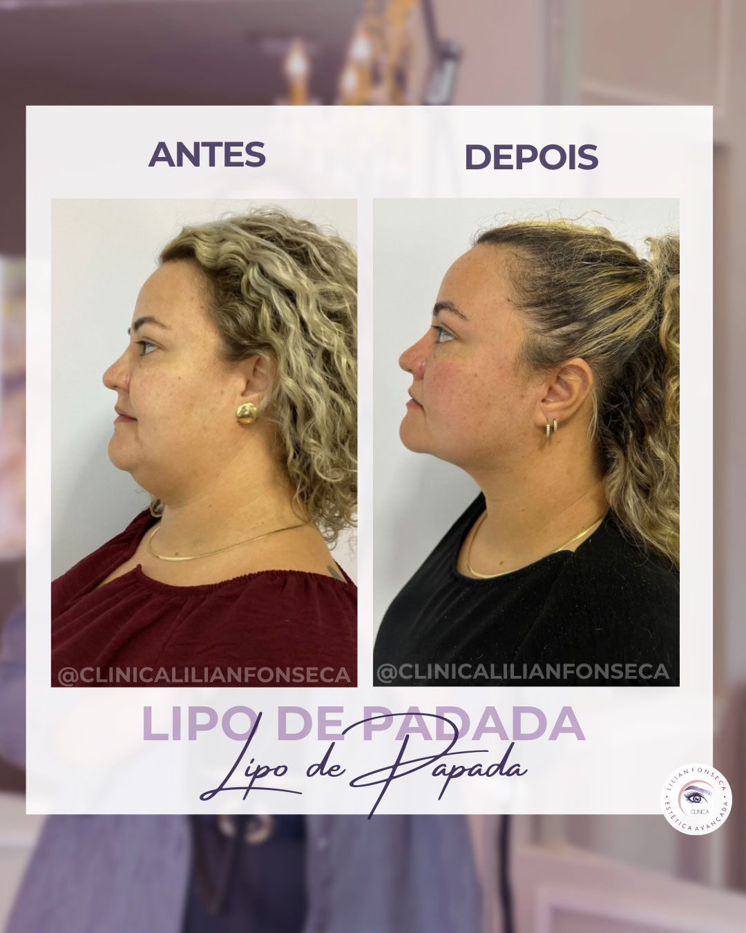 Resultado de Lipo de Papada 2
