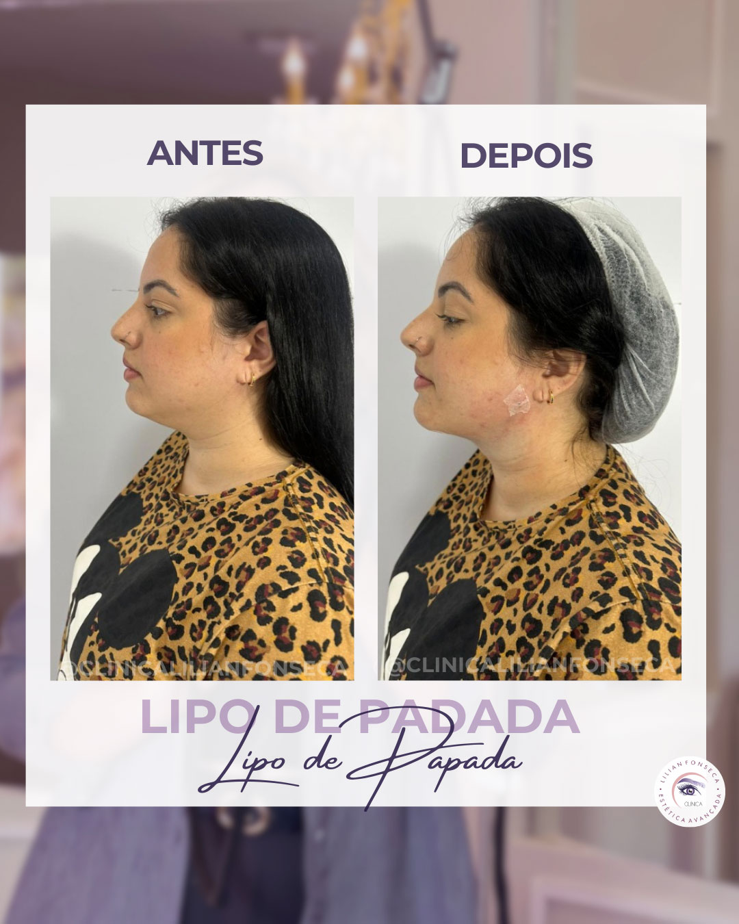 Resultado de Lipo de Papada 4