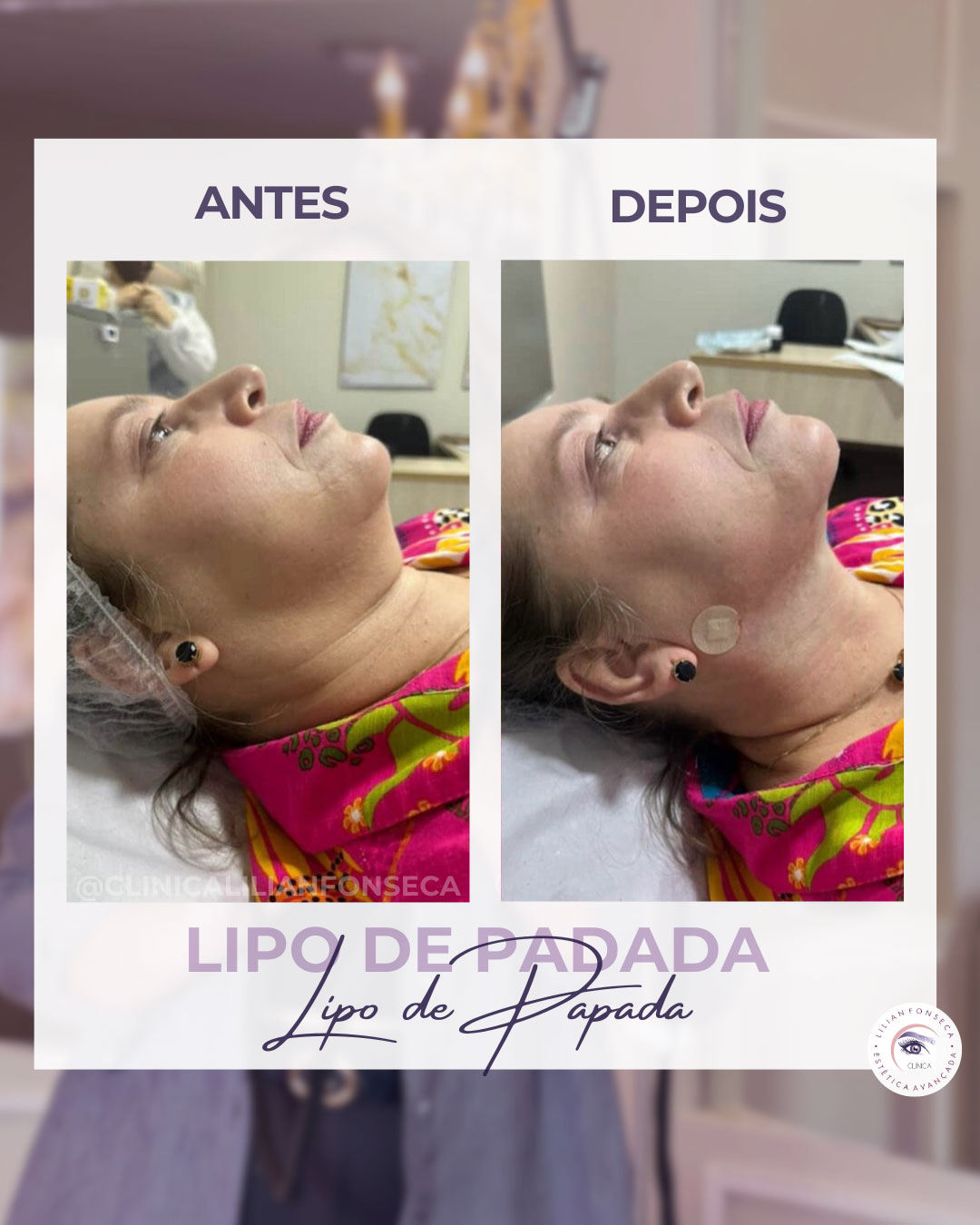 Resultado de Lipo de Papada 5