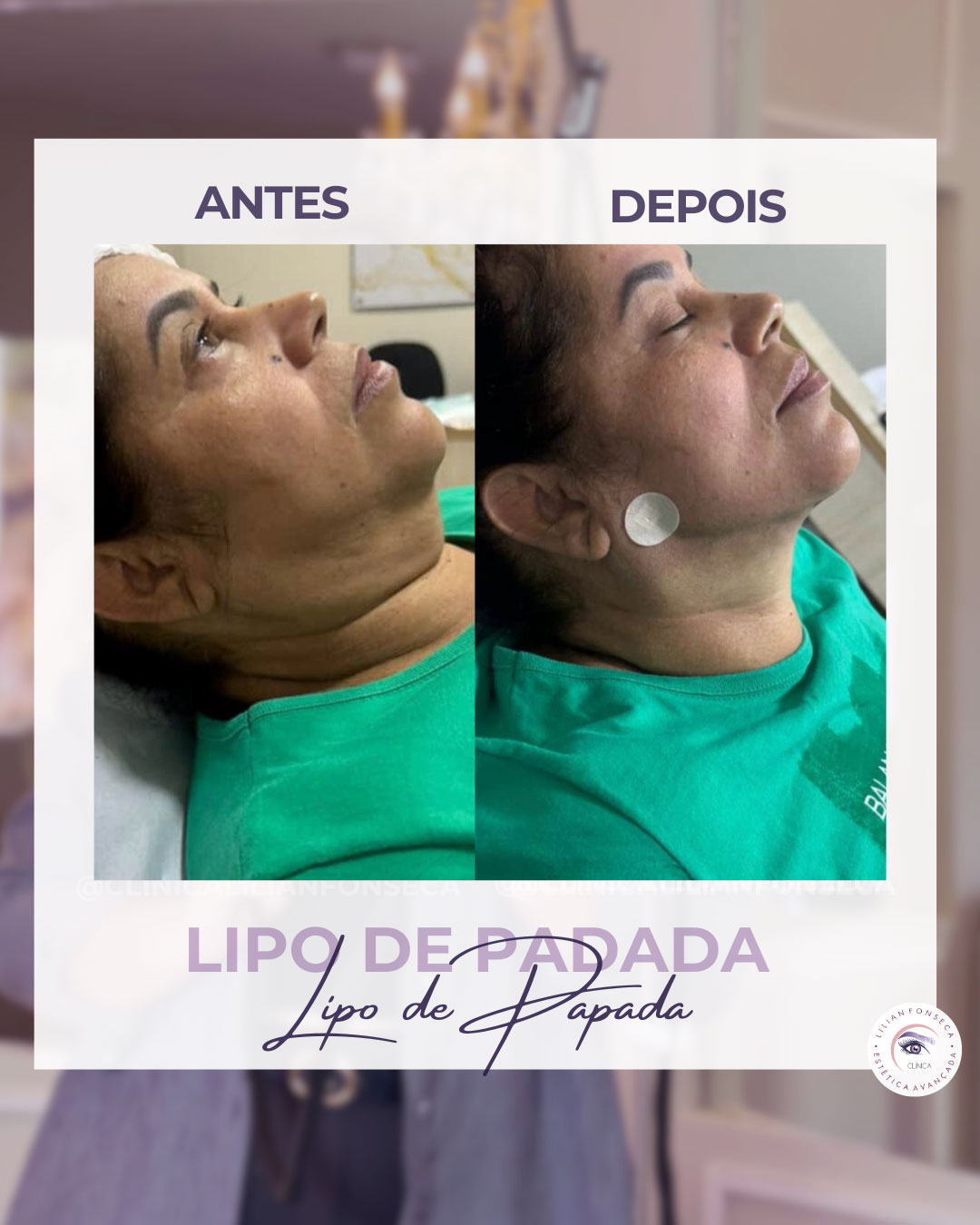 Resultado de Lipo de Papada 6