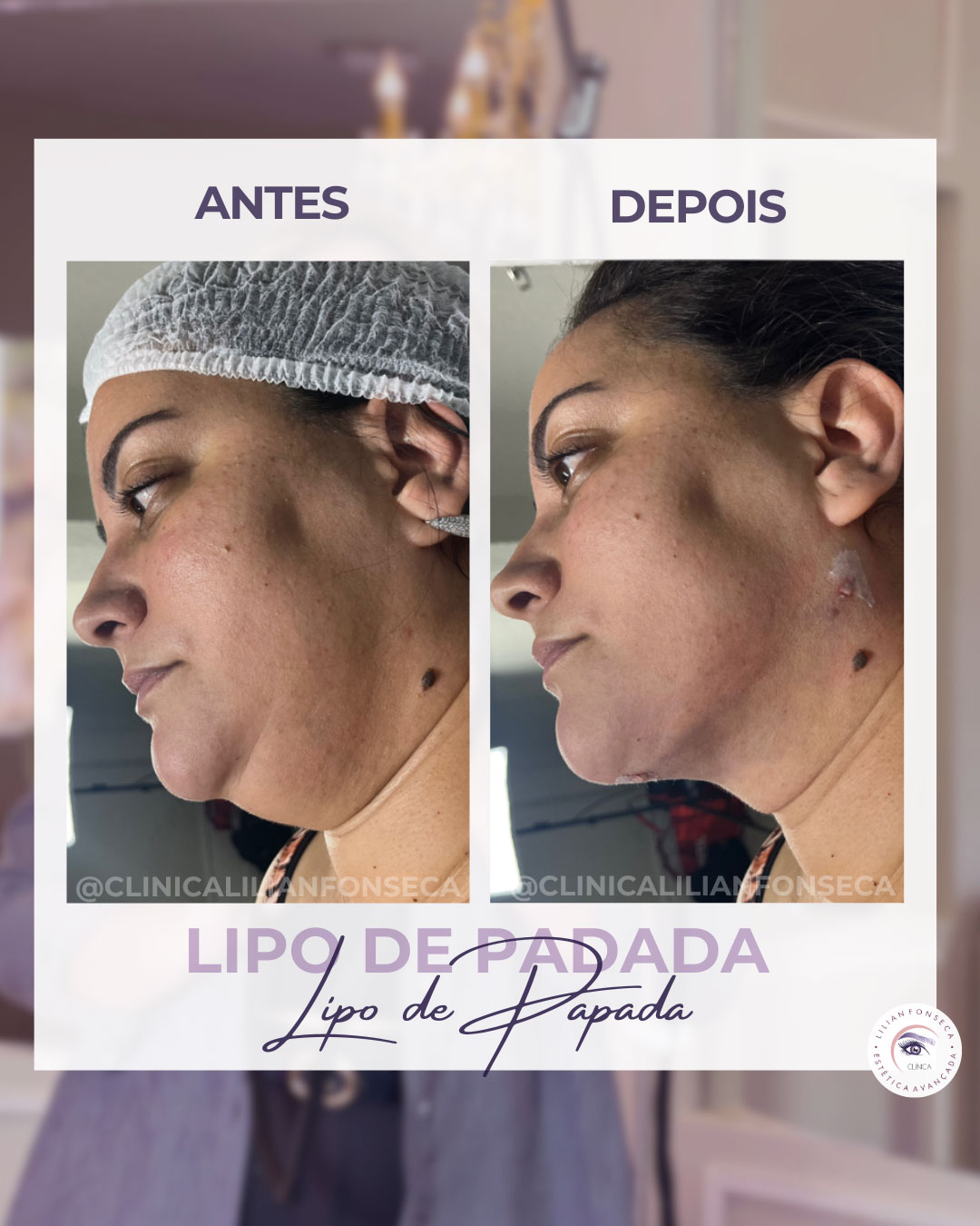 Resultado de Lipo de Papada 7