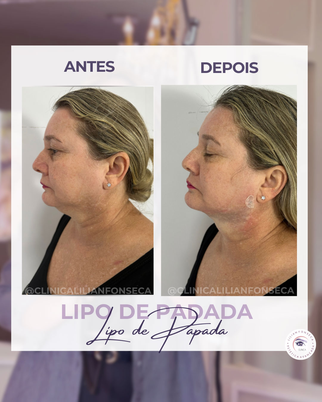 Resultado de Lipo de Papada 8