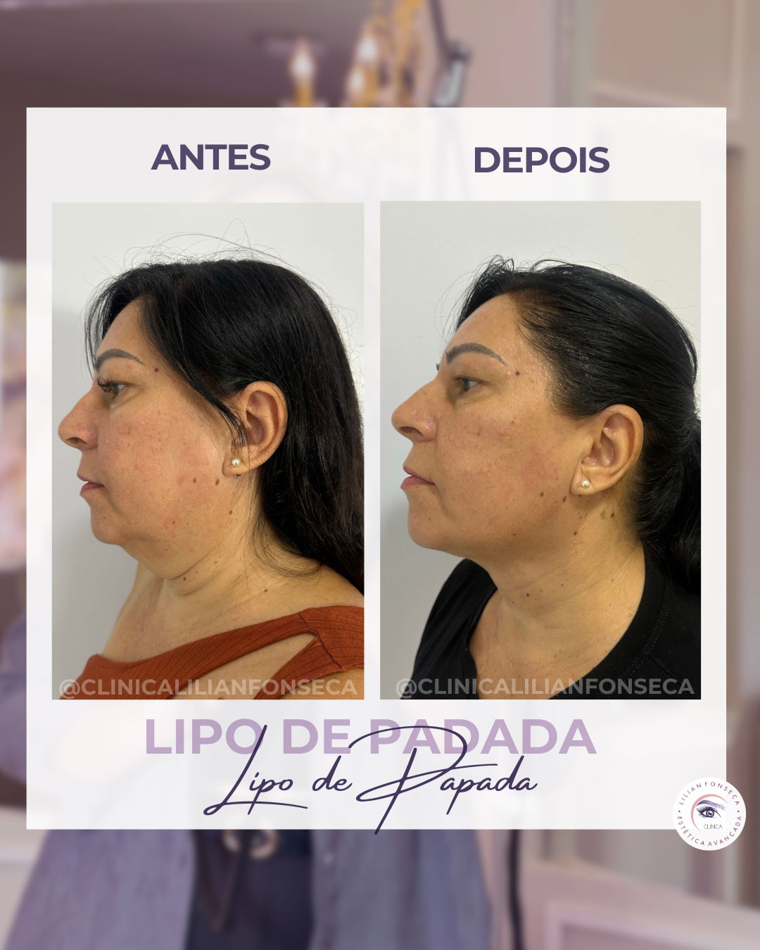 Resultado de Lipo de Papada 9