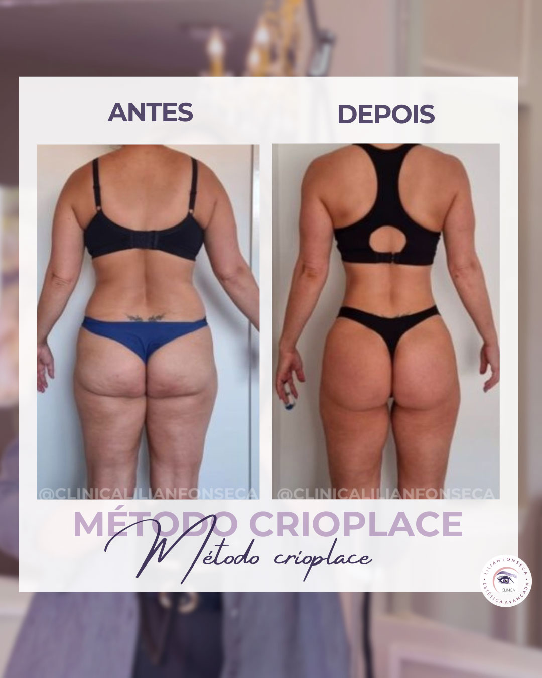 Resultado de tratamento 3