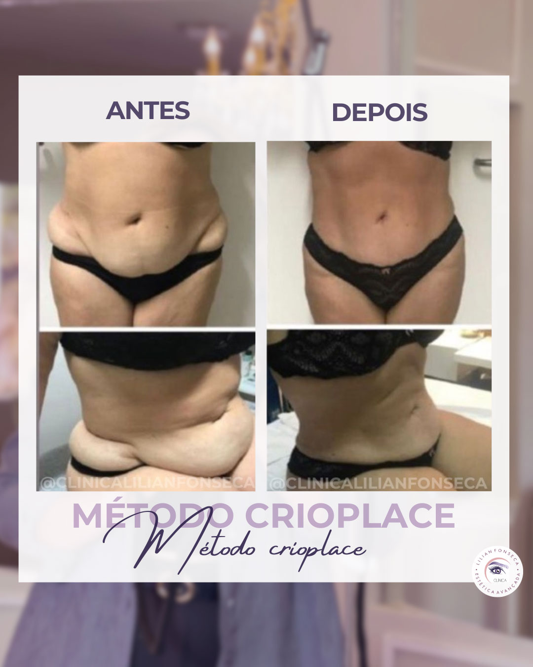 Resultado de tratamento 4