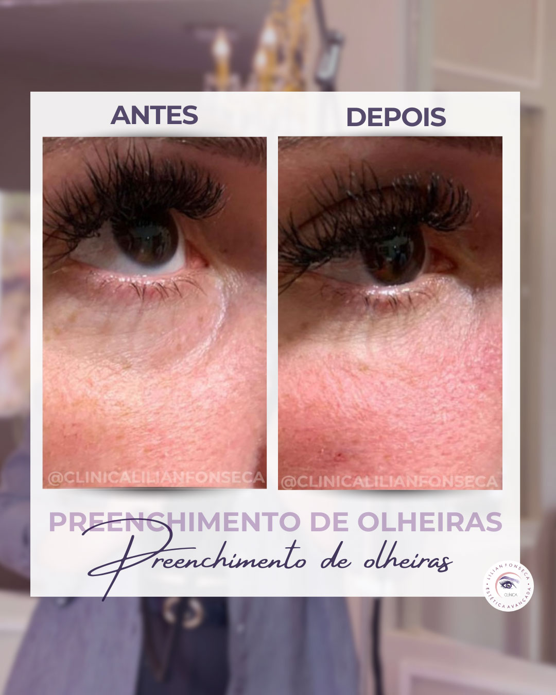 Antes e depois preenchimento de olheiras