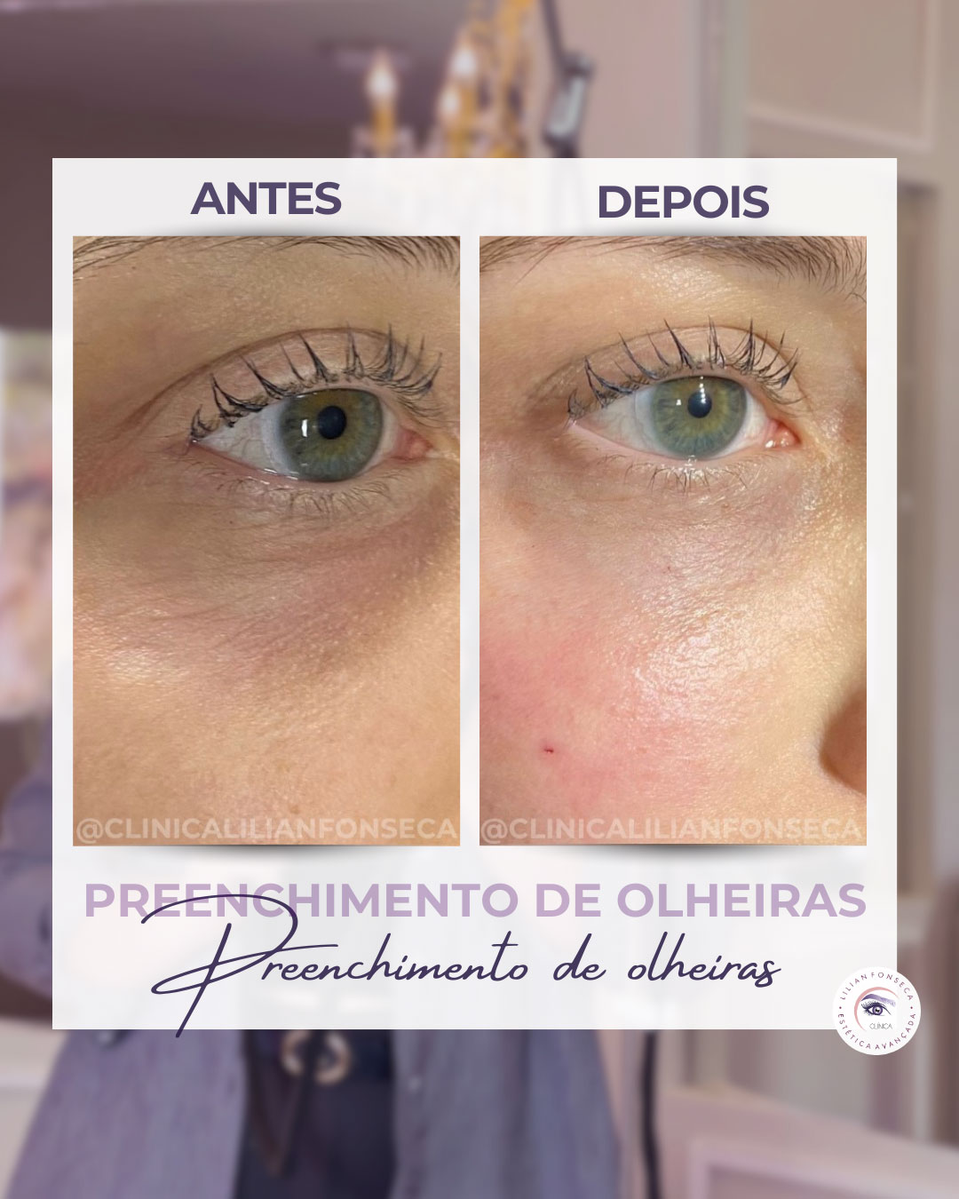 Antes e depois preenchimento de olheiras