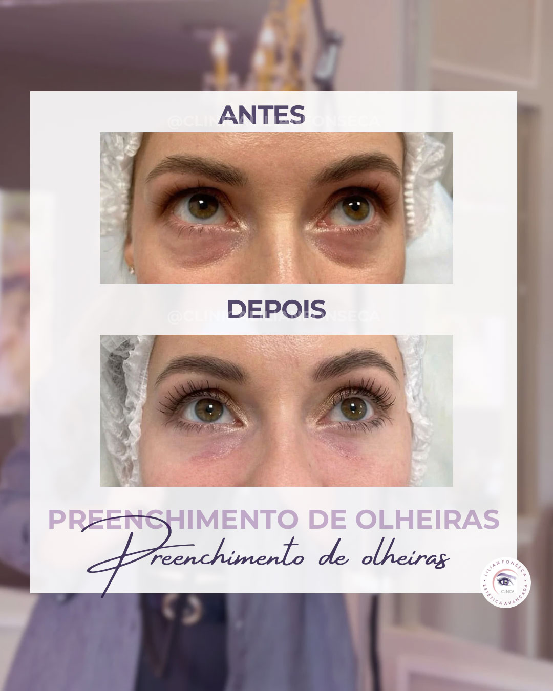 Antes e depois preenchimento de olheiras