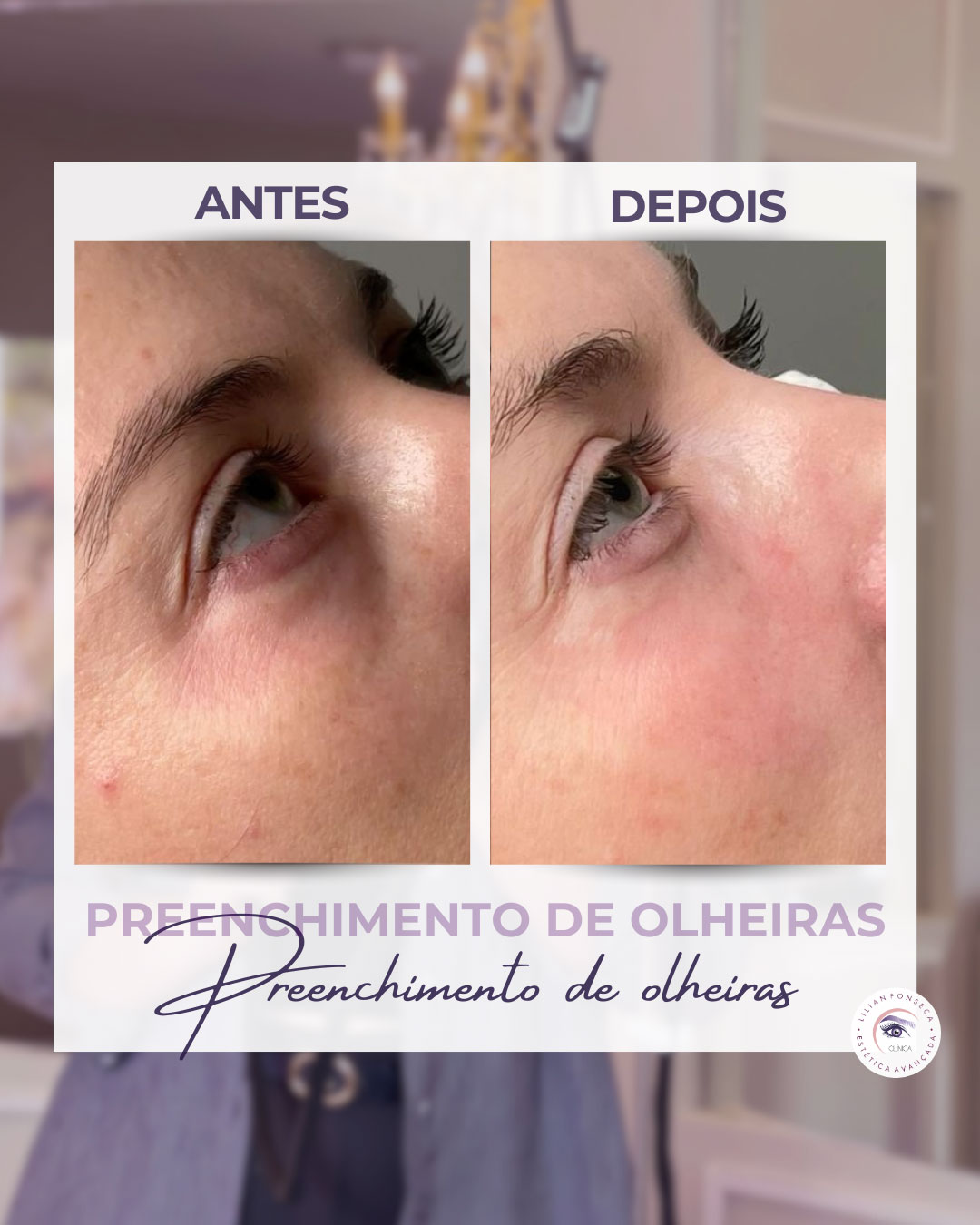 Antes e depois preenchimento de olheiras