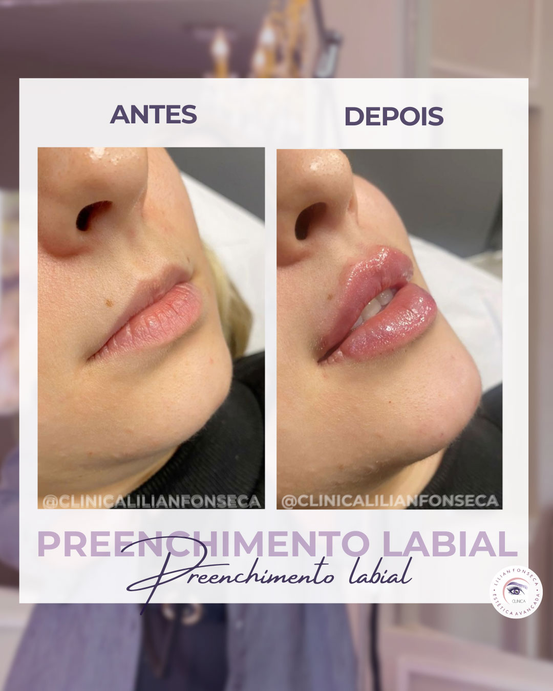 Antes e depois preenchimento labial
