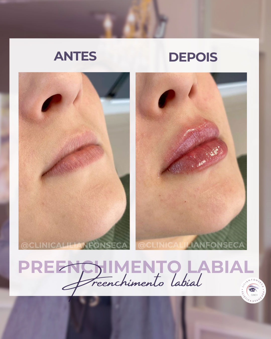 Antes e depois preenchimento labial