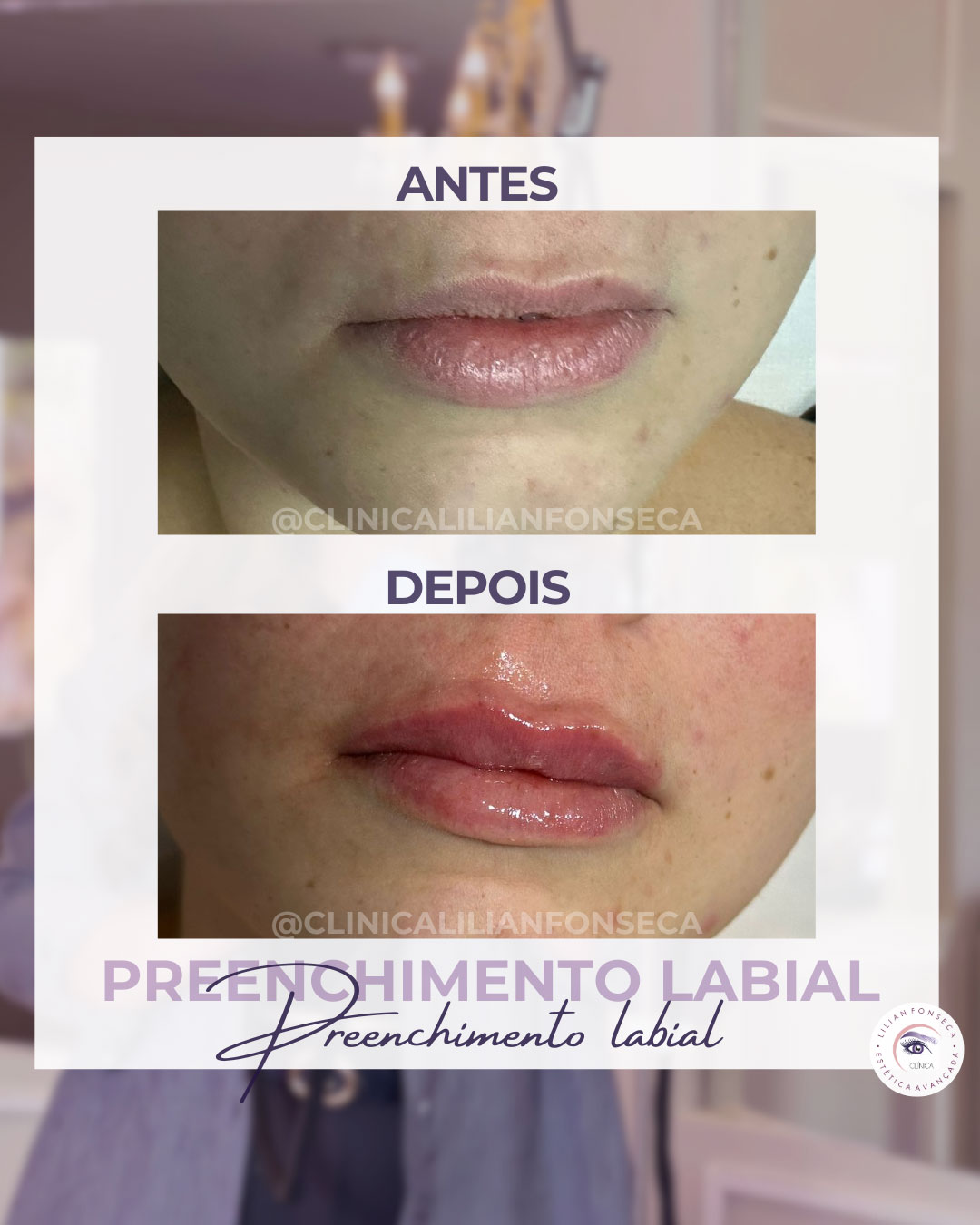 Antes e depois preenchimento labial