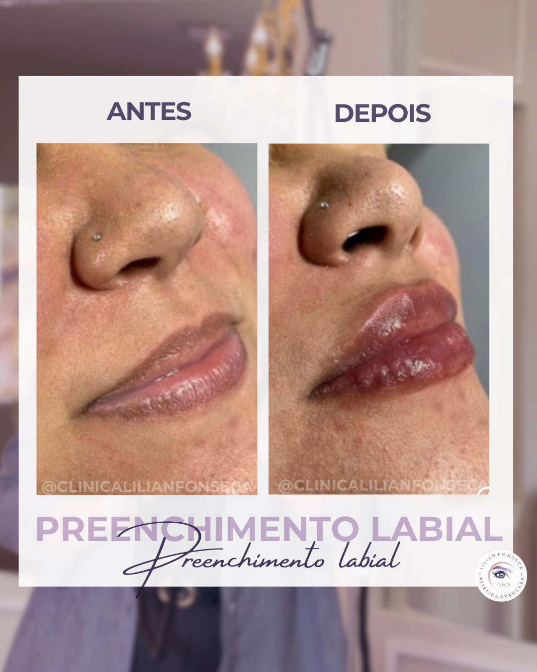 Antes e depois preenchimento labial