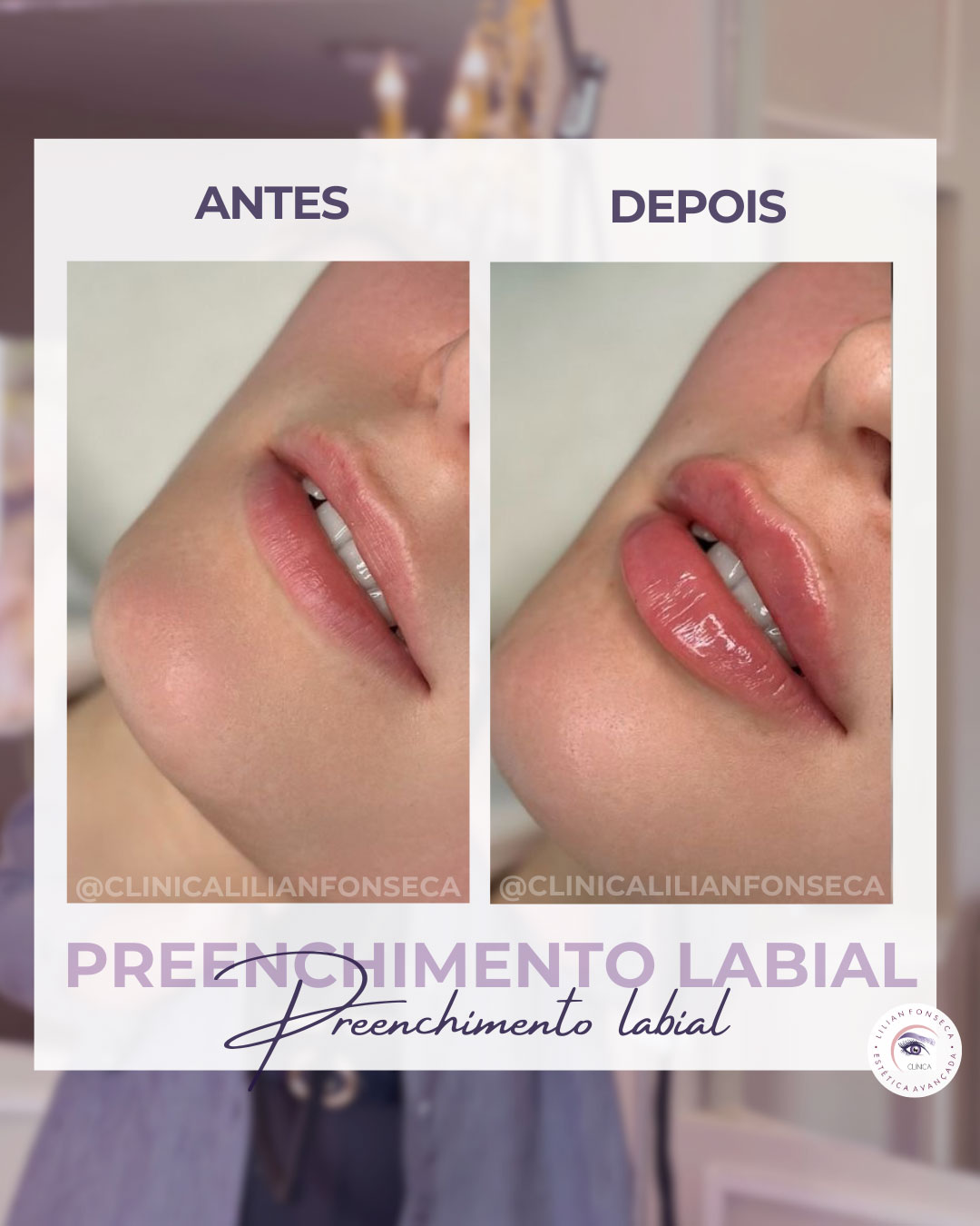 Antes e depois preenchimento labial