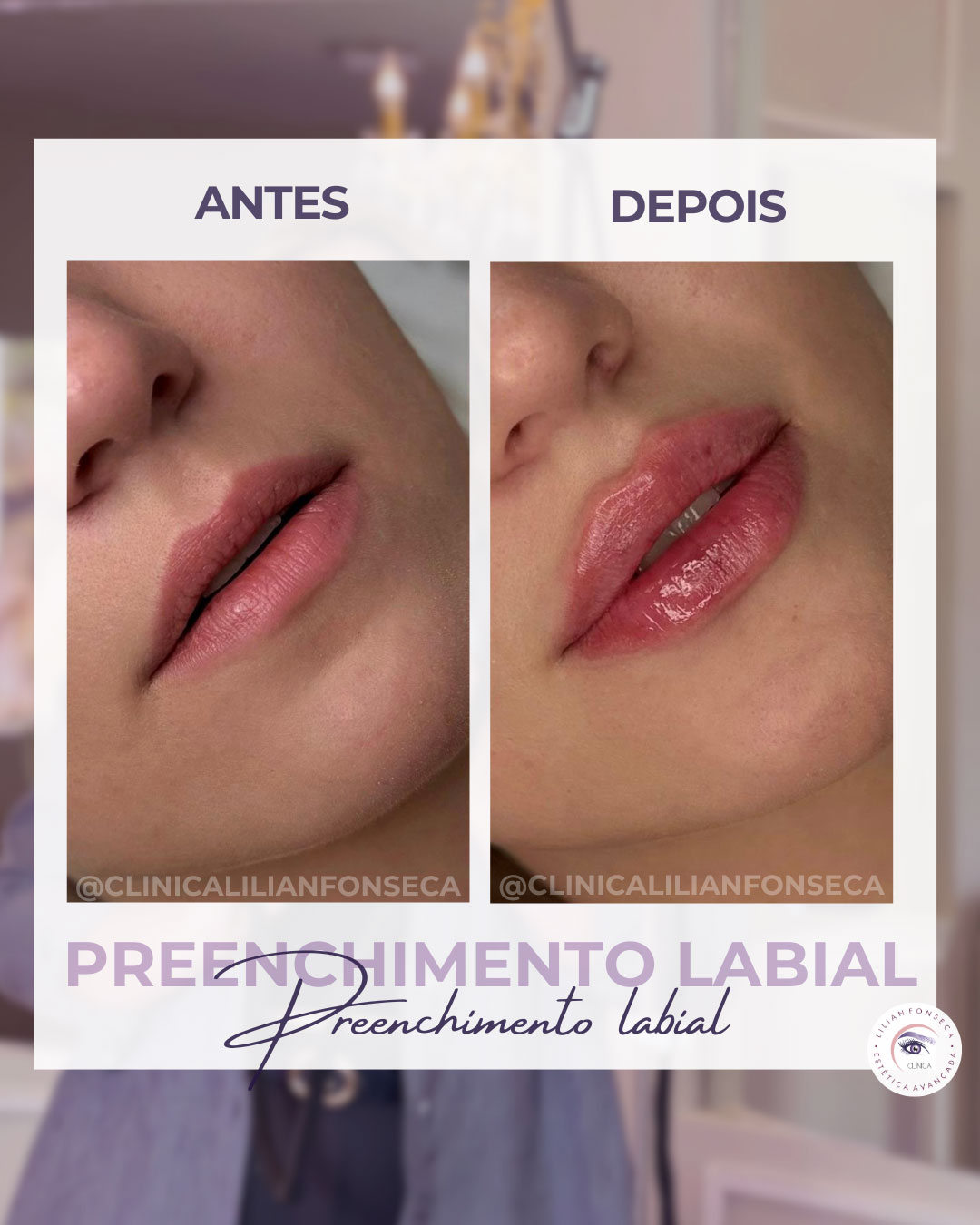 Antes e depois preenchimento labial