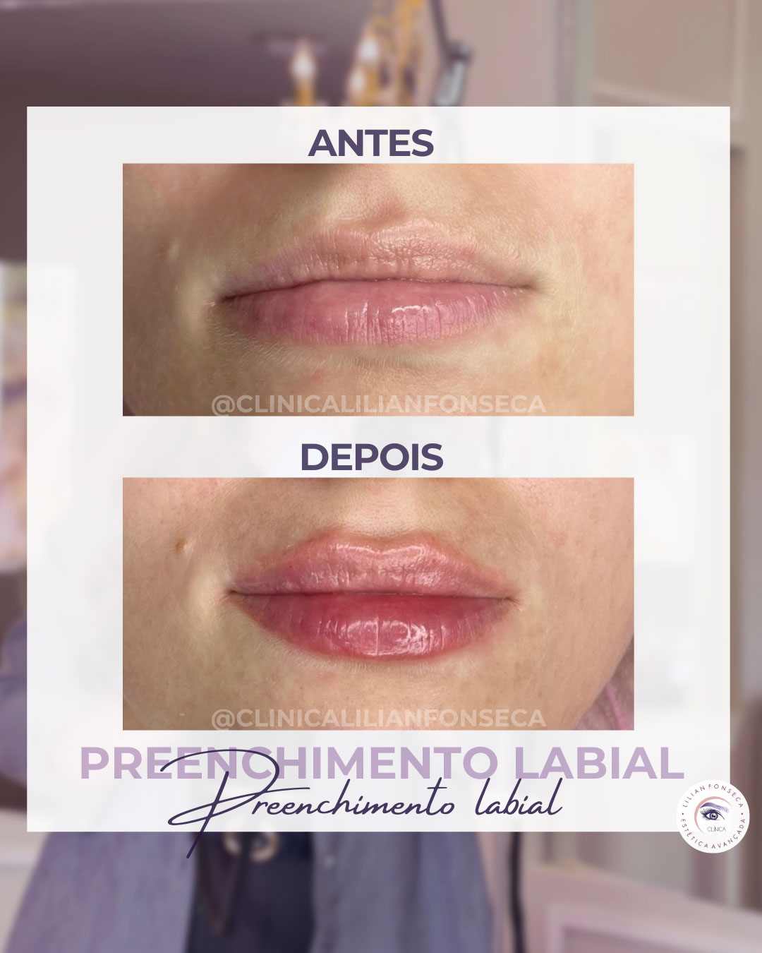 Antes e depois preenchimento labial