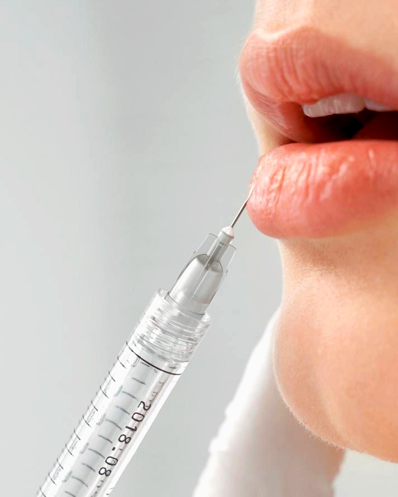 Preenchimento Labial na Clínica Lilian Fonseca
