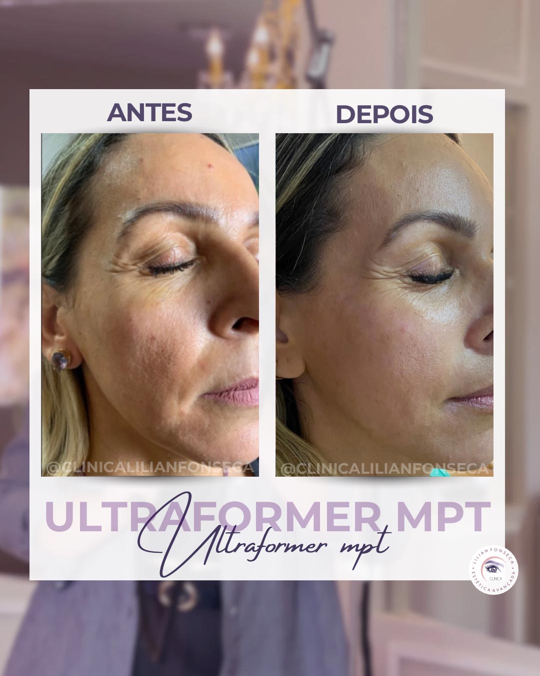 Resultado de tratamento Ultraformer MPT 1