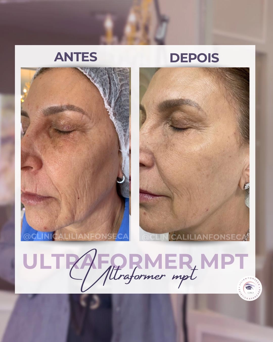 Resultado de tratamento Ultraformer MPT 10