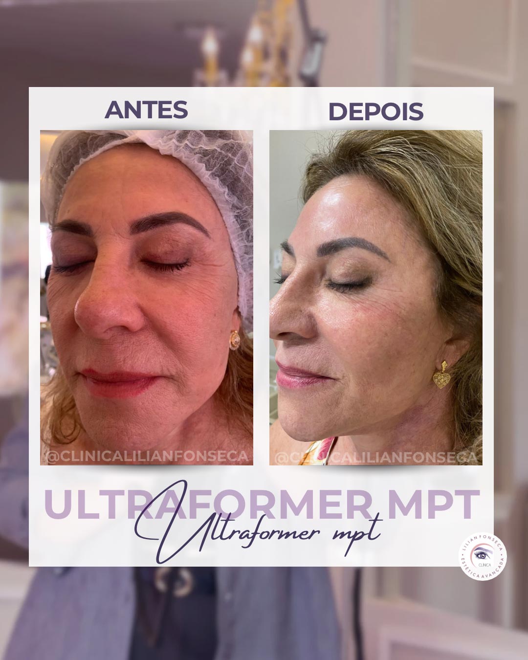 Resultado de tratamento Ultraformer MPT 11