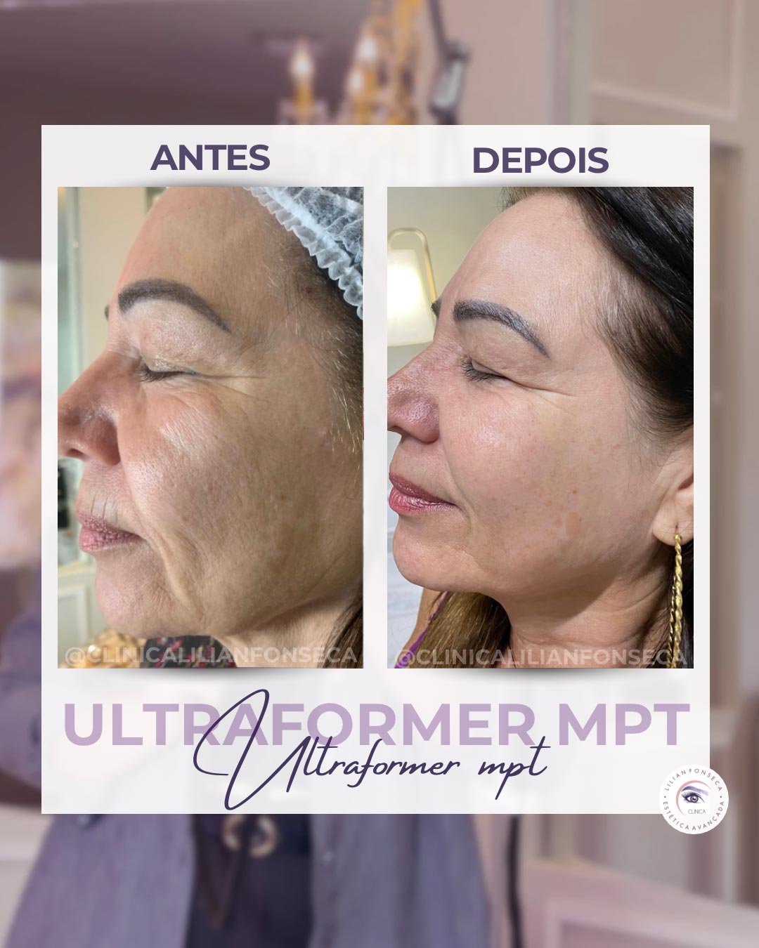 Resultado de tratamento Ultraformer MPT 12