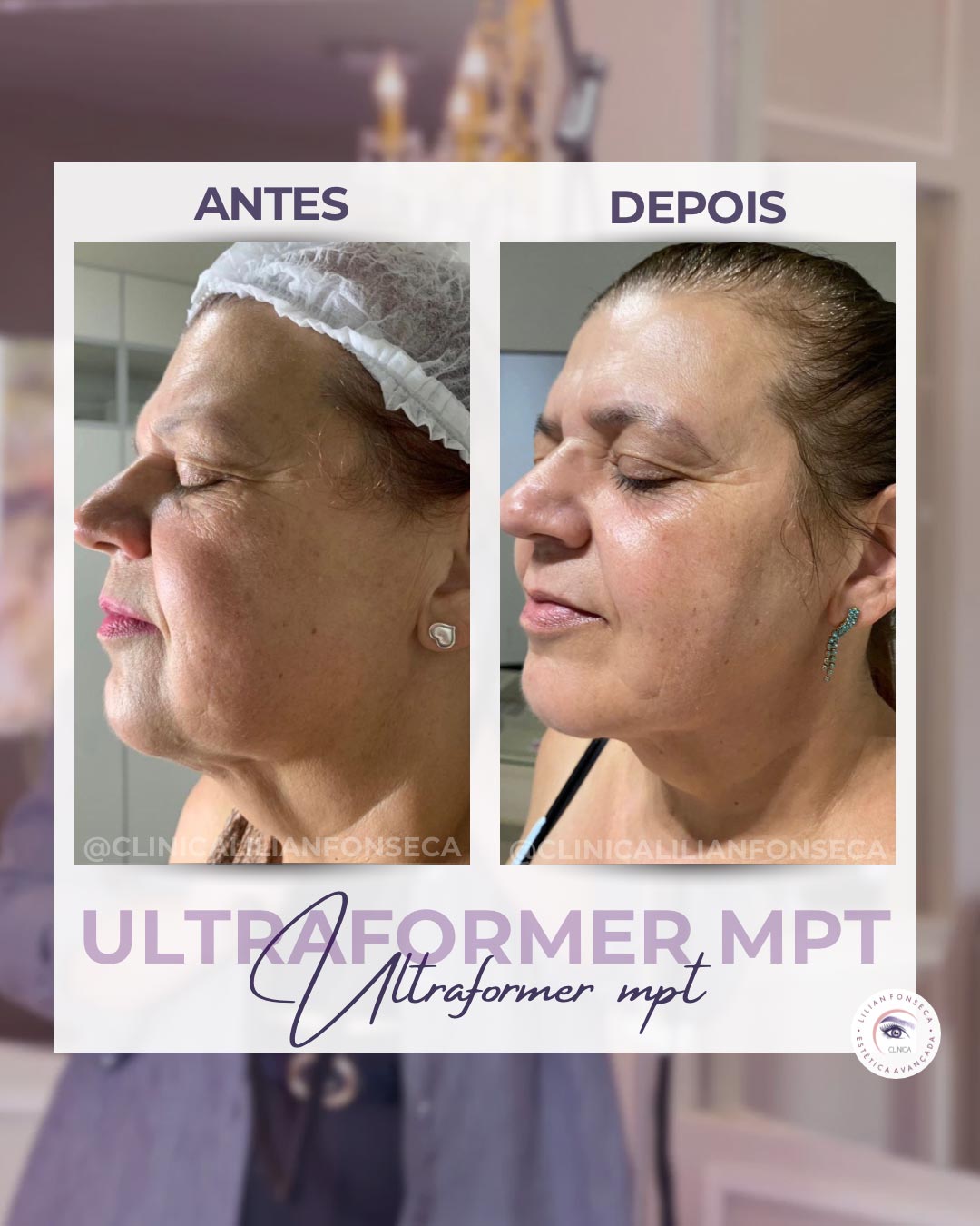 Resultado de tratamento Ultraformer MPT 14