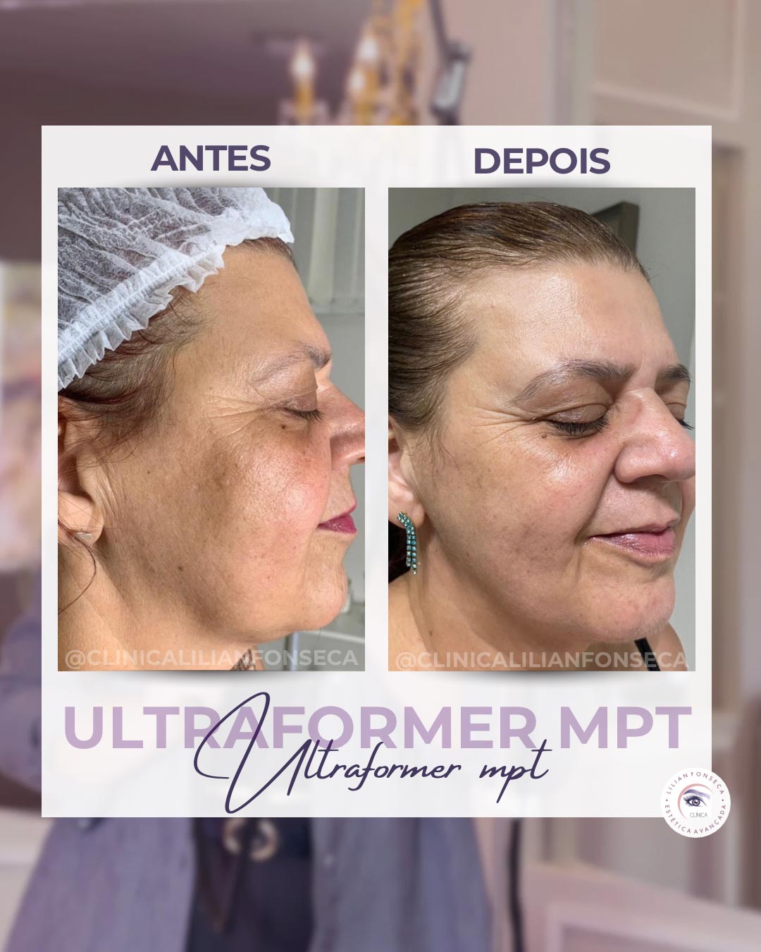 Resultado de tratamento Ultraformer MPT 2