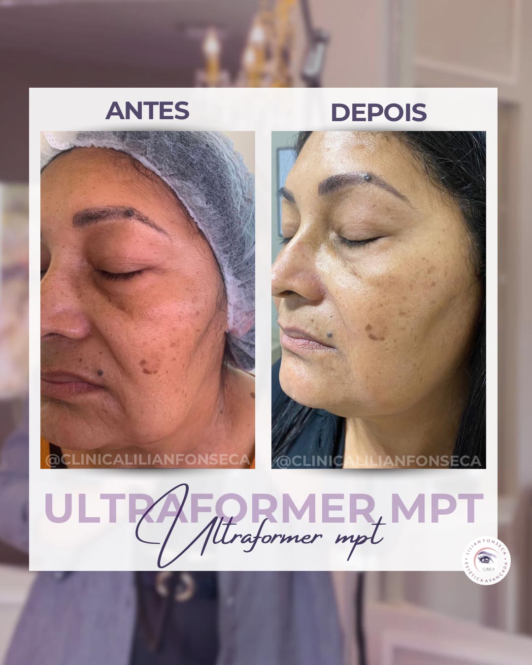 Resultado de tratamento Ultraformer MPT 3