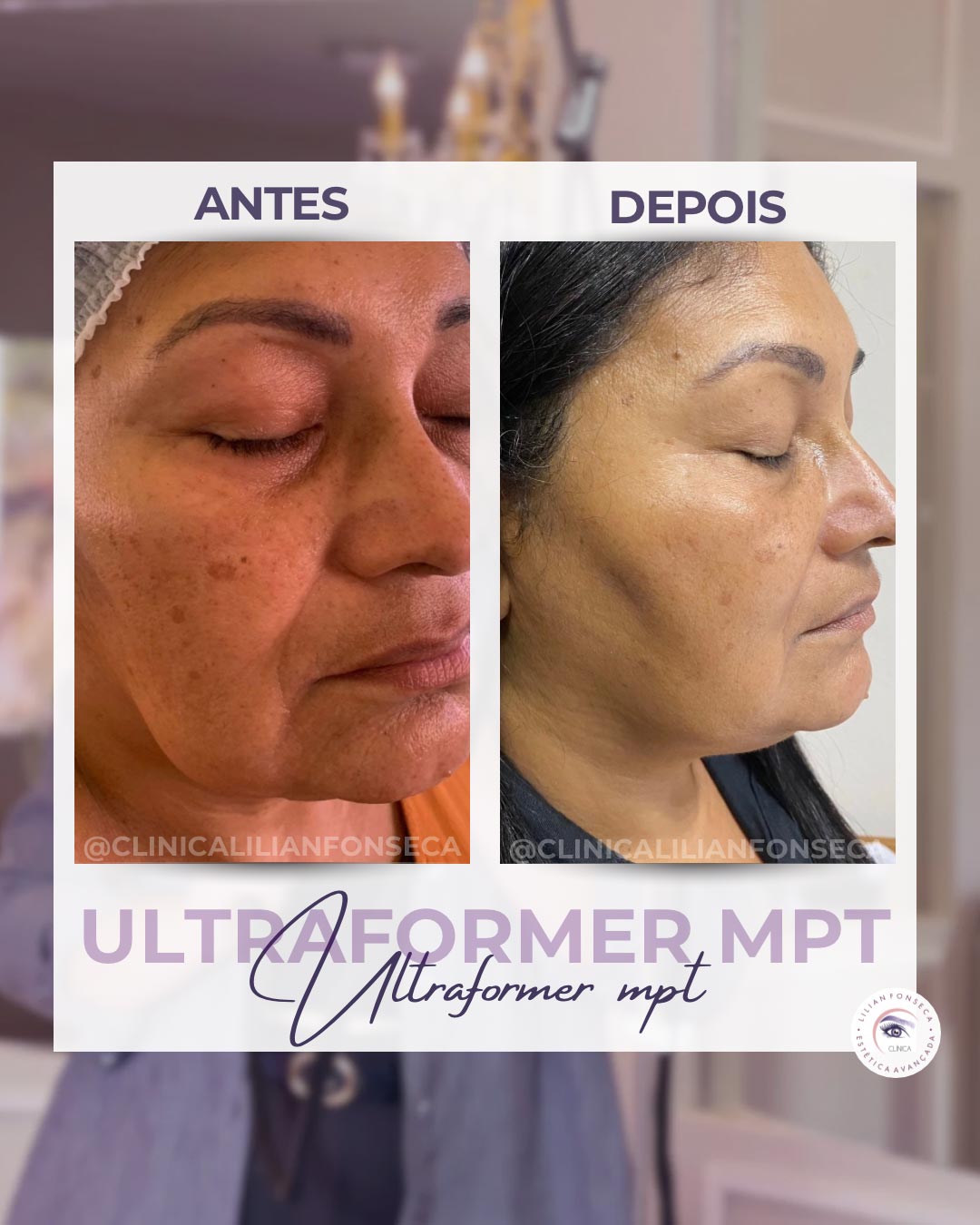 Resultado de tratamento Ultraformer MPT 4