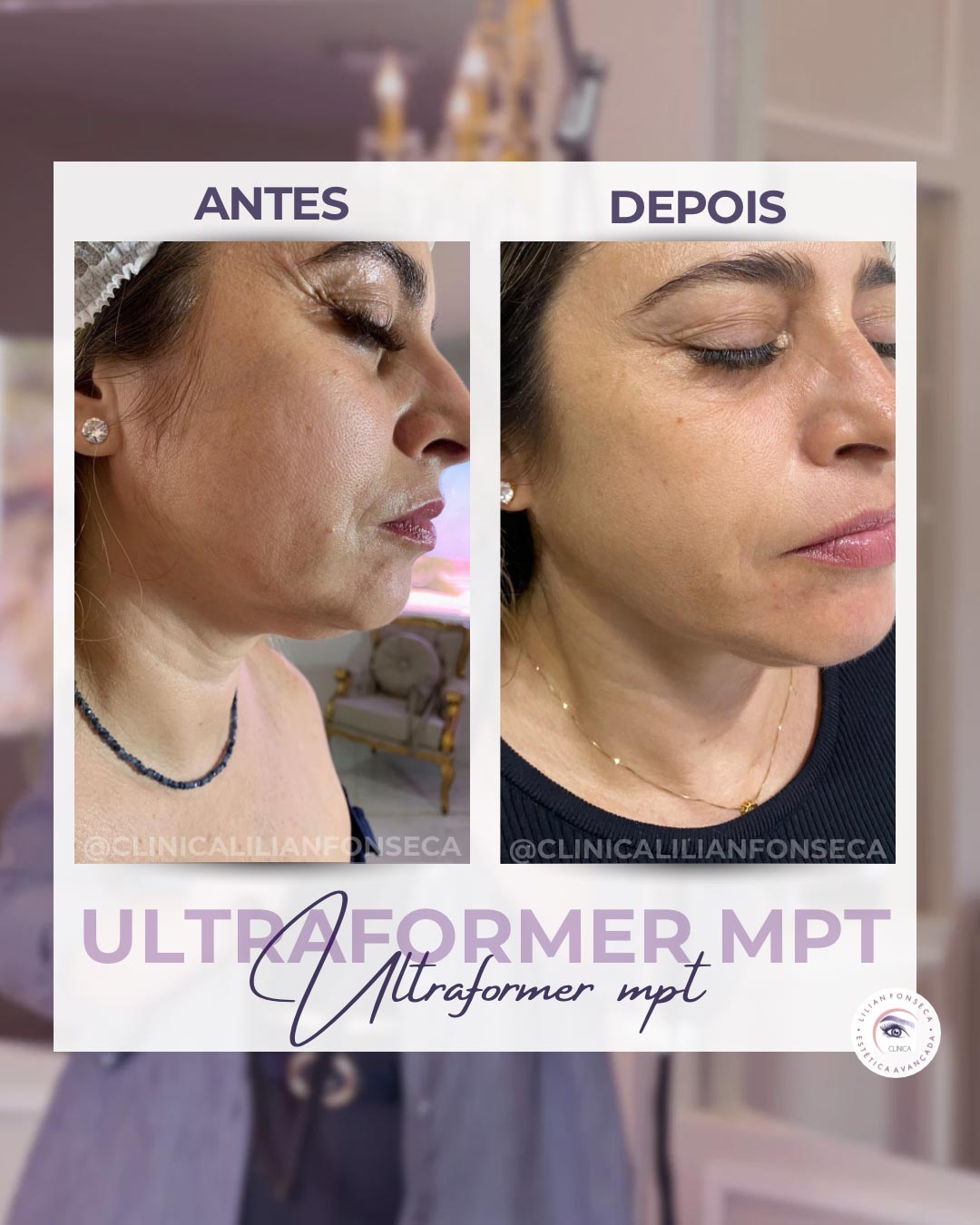 Resultado de tratamento Ultraformer MPT 5