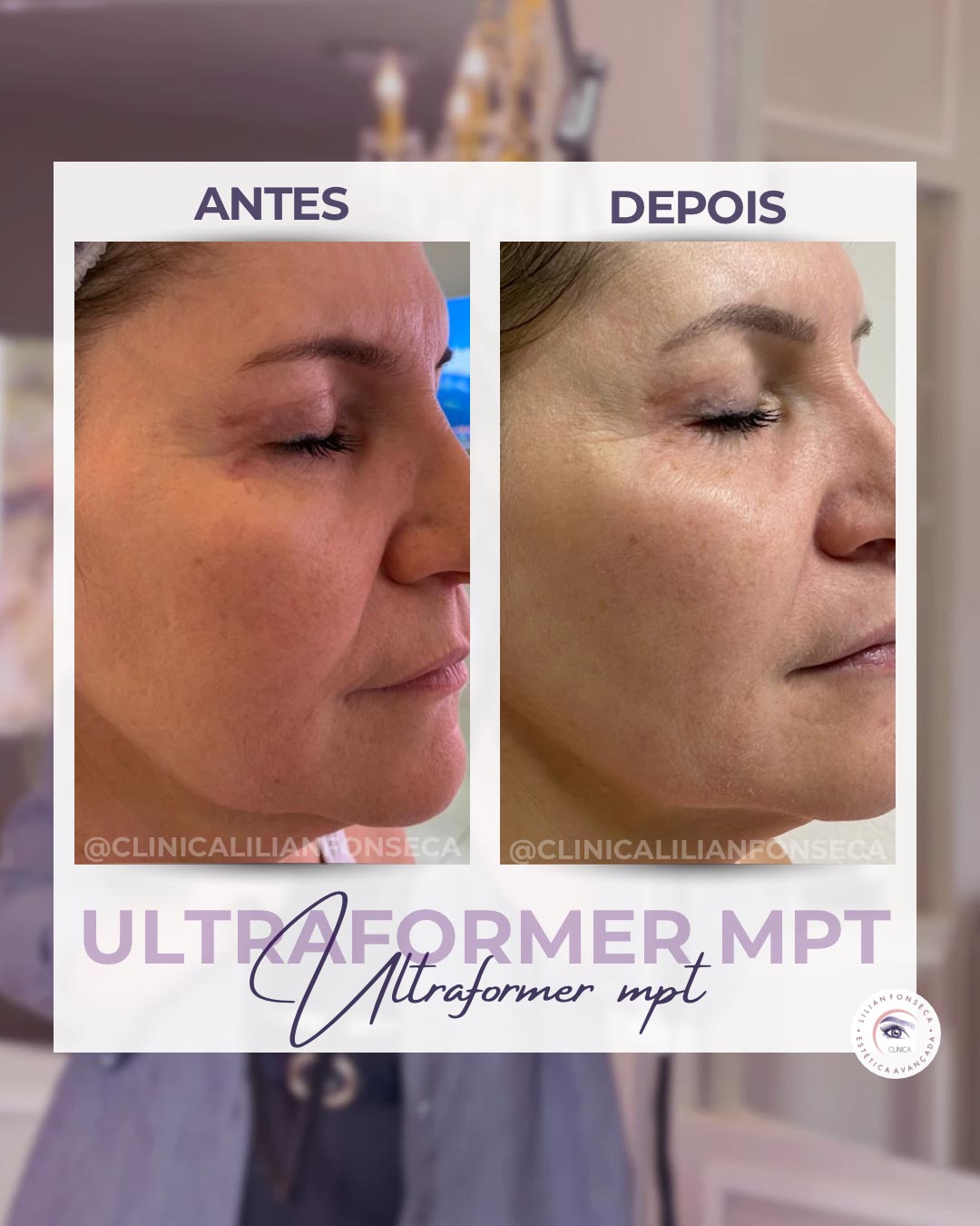 Resultado de tratamento Ultraformer MPT 6