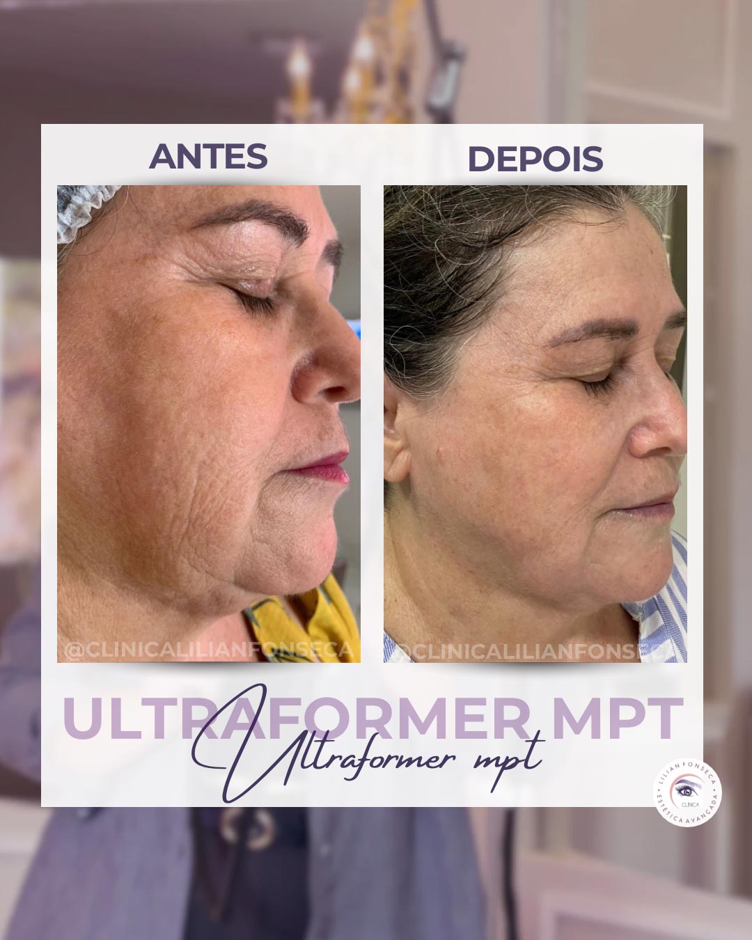 Resultado de tratamento Ultraformer MPT 7
