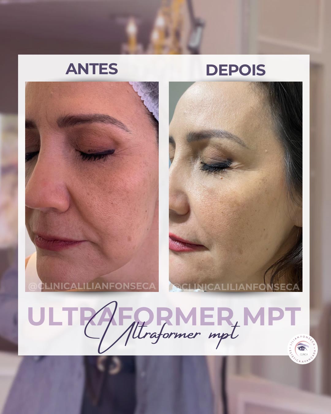Resultado de tratamento Ultraformer MPT 9